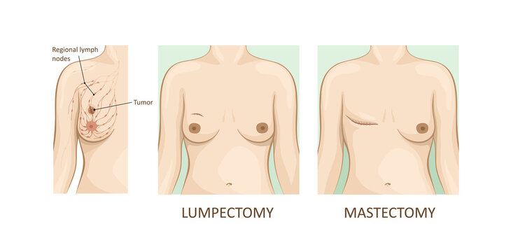 Read more about the article Mastectomy vs. Lumpectomy