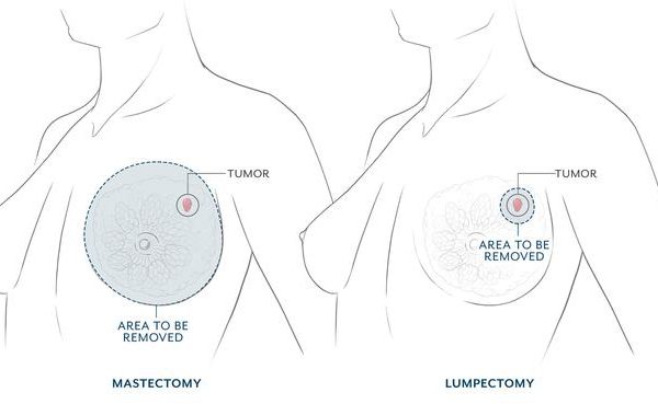 Mastectomy vs. Lumpectomy – Kali Kicks Cancer